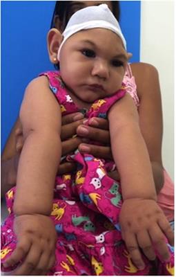 The Characterisation of the Craniofacial Morphology of Infants Born With Zika Virus; Innovative Approach for Public Health Surveillance and Broad Clinical Applications